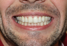 Zahnstellung NACH der Behandlung mit Invisalign®