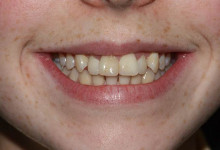 Zahnstellung VOR der Behandlung mit Invisalign®