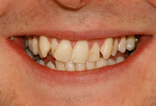 Zahnstellung VOR der Behandlung mit Invisalign®